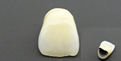 メタルセラミッククラウン