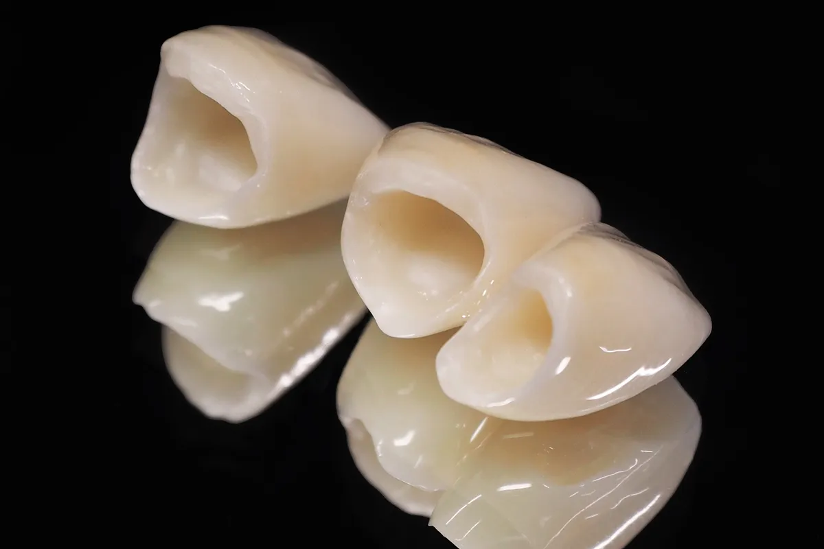 セレックによるセラミック治療