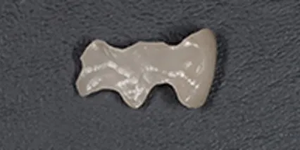 セレック ジルコニアインレー