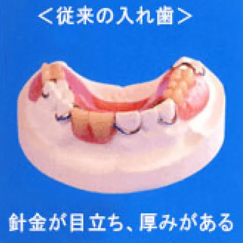 従来の入れ歯
