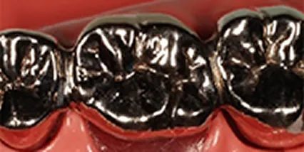 銀歯（保険適応）