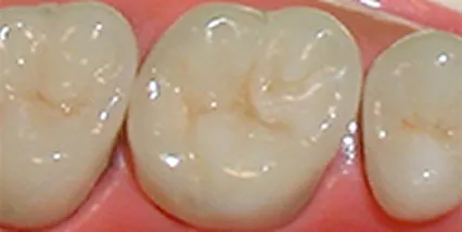 メタルセラミッククラウン