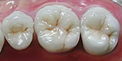 ジルコニアクラウン