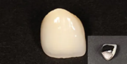 硬質レジン前装冠（保険適応）