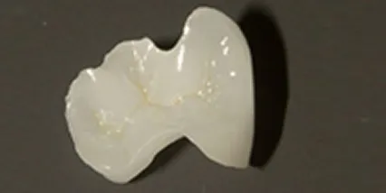 セレック ジルコニアインレー