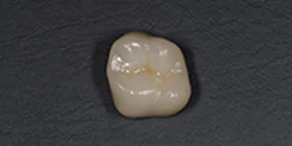 セレック ジルコニアクラウン