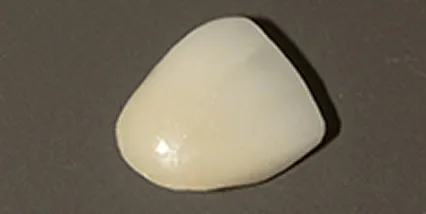 ラミネートベニア セラミック