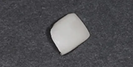 ラミネートベニア ジルコニア