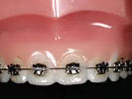 メタルブラケット