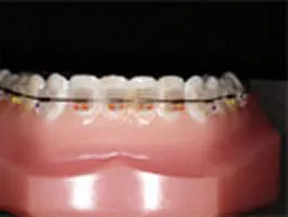 クリアブラケット