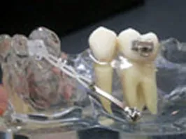 セレックインプラントアンカー