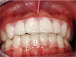 クリアアライナー