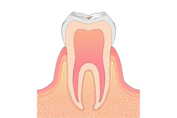 むし歯の種類01