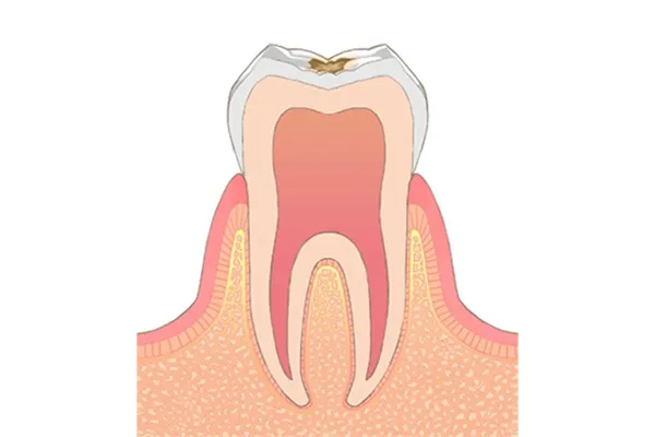むし歯の種類02