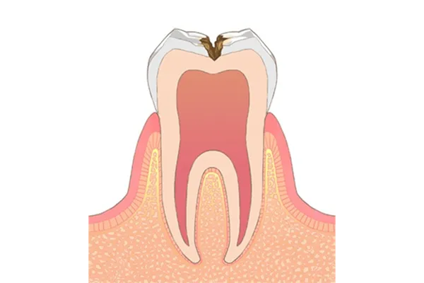 むし歯の種類03