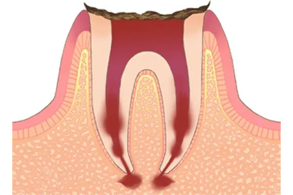 むし歯の種類05