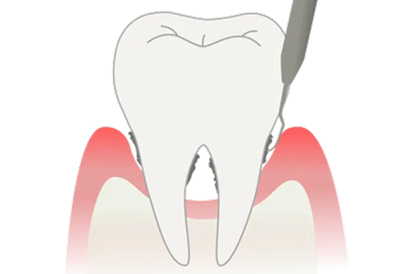 ルートプレーニング