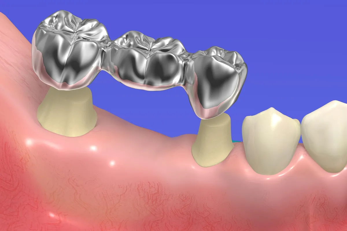 ブリッジのメリットデメリット