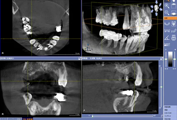 インプラント治療の流れ
