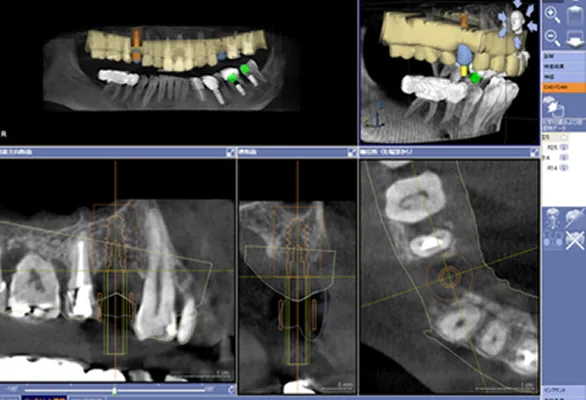インプラント治療の流れ