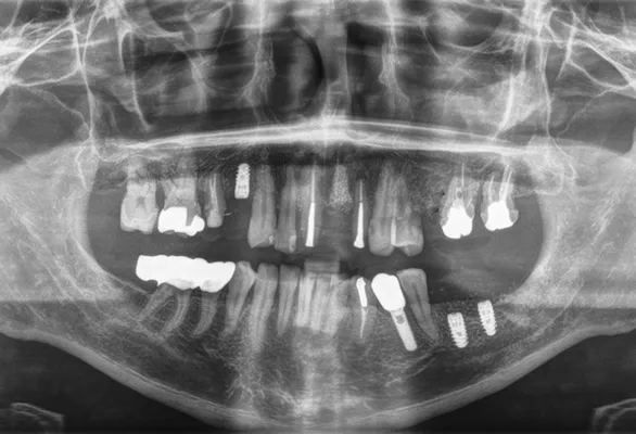 インプラント治療の流れ