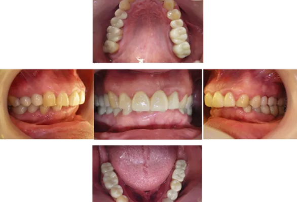 インプラント治療の流れ