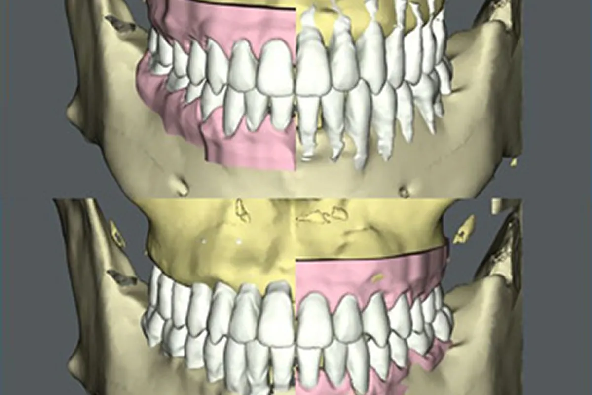 歯根から歯冠まで